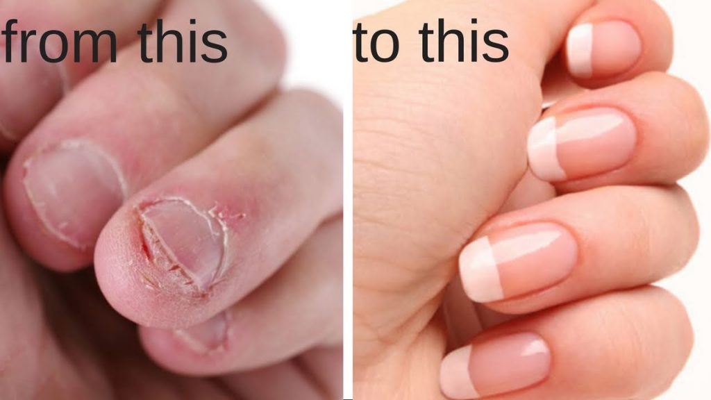 how to stop nail-biting
